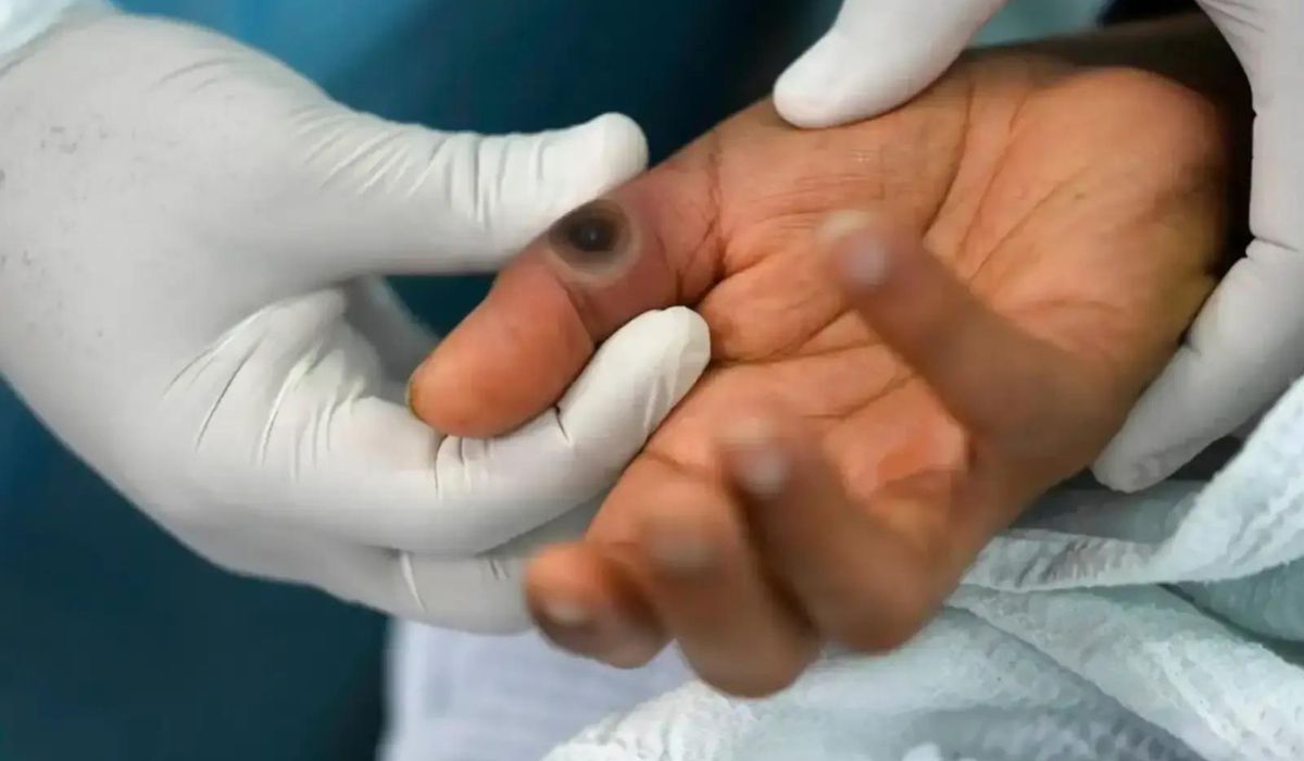 Philippines has Reported its First Mpox Case of 2024